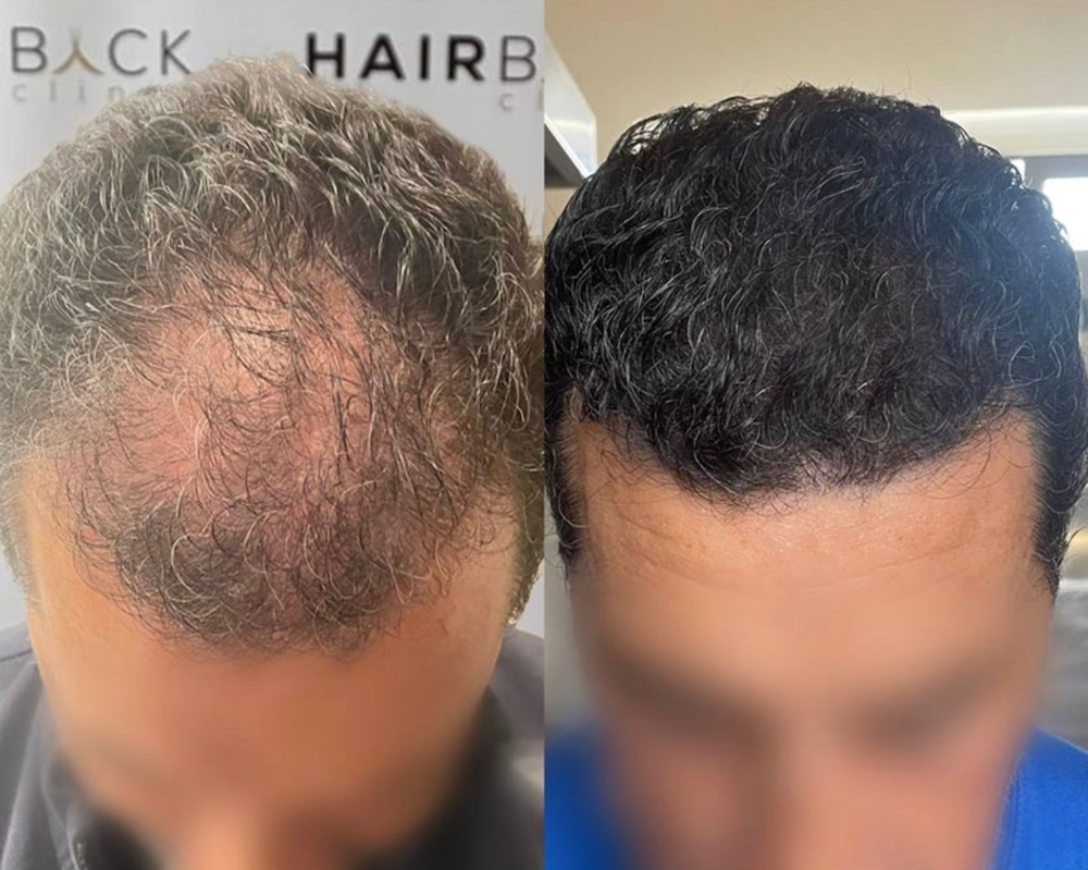 Choisir la meilleure clinique de greffe de cheveux en Turquie